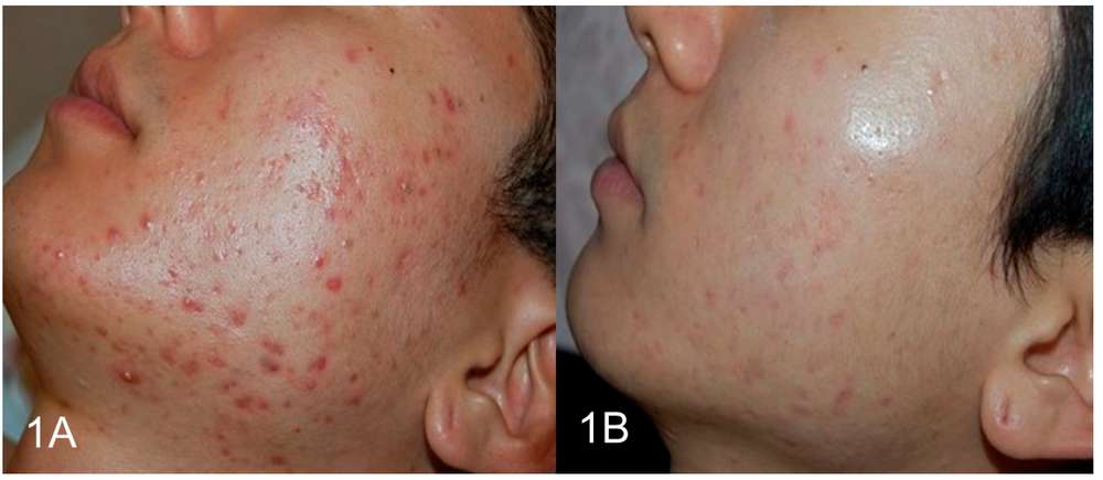Fig.1 Clinical Improvement in Inflammatory Acne Following Topical Exosome Application.